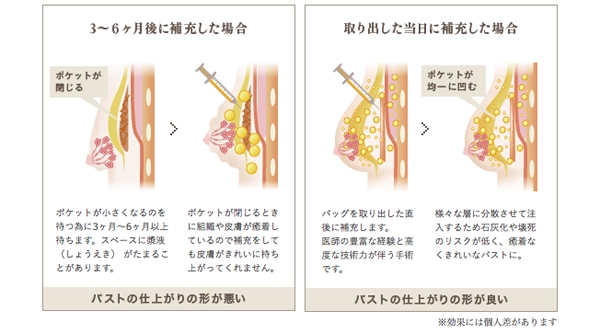 豊胸手術 シリコンバッグ抜去 脂肪注入