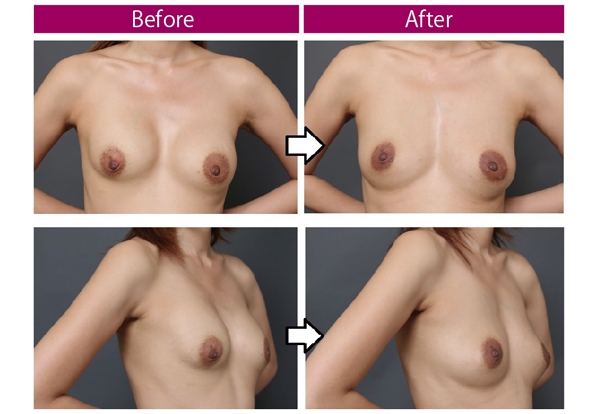 豊胸手術 シリコンバッグ失敗 画像