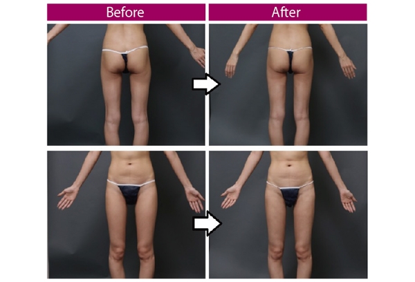 豊胸手術 脂肪注入 脂肪吸引