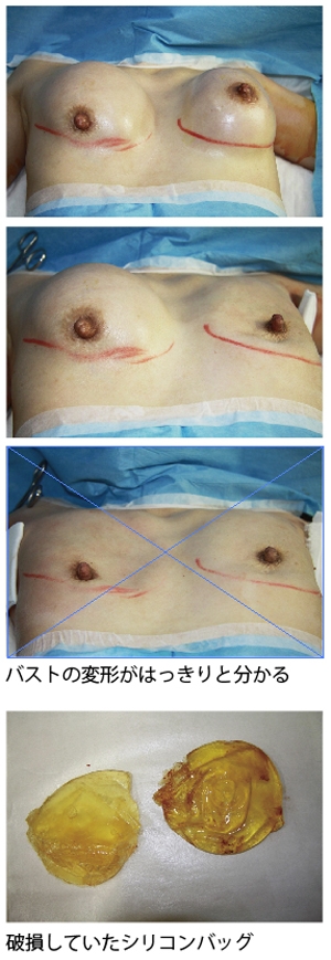 豊胸手術 シリコンバッグ抜去 画像