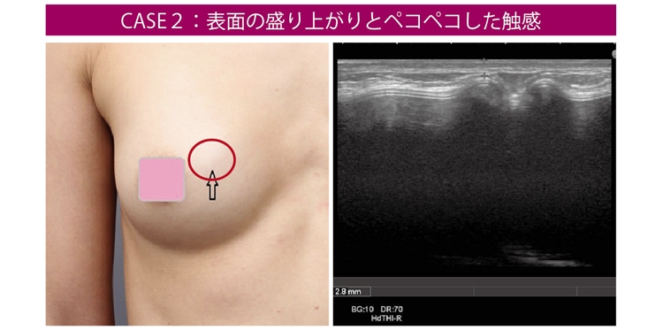 豊胸手術 シリコンバッグ リップリング