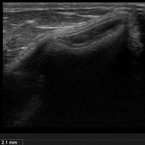 豊胸シリコンバッグ リップリング 画像