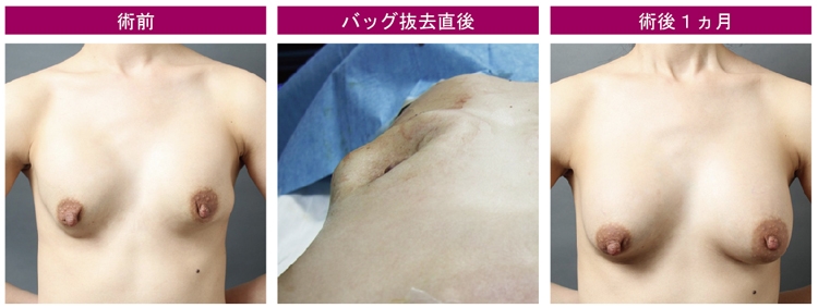 シリコンバッグ豊胸 除去 症例画像