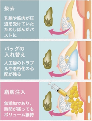 シリコンバッグ 抜去 脂肪注入