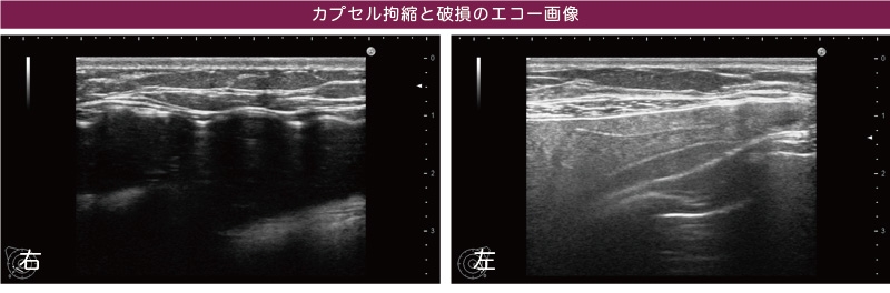 シリコンバッグ 破損 エコー画像
