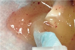 シリコン 豊胸 トラブル