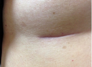 シリコンバッグ 摘出 傷