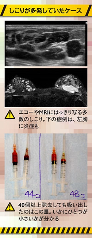 ヒアルロン酸 豊胸 しこり