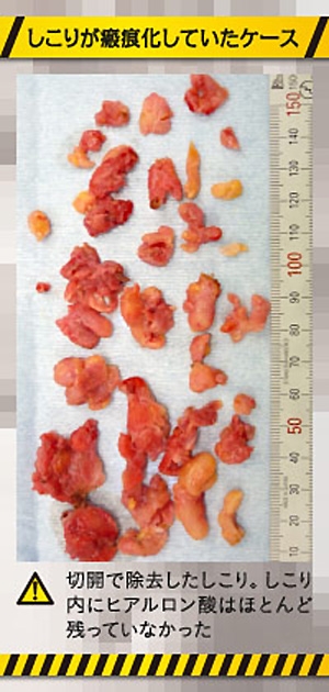 ヒアルロン酸 豊胸 瘢痕化