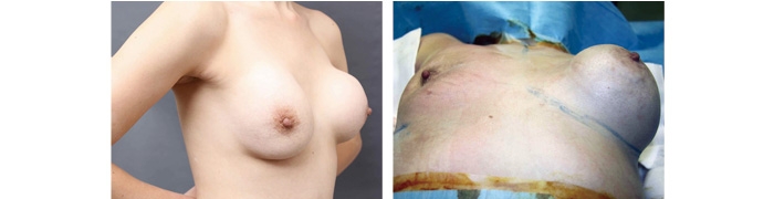 シリコンバッグ 拘縮