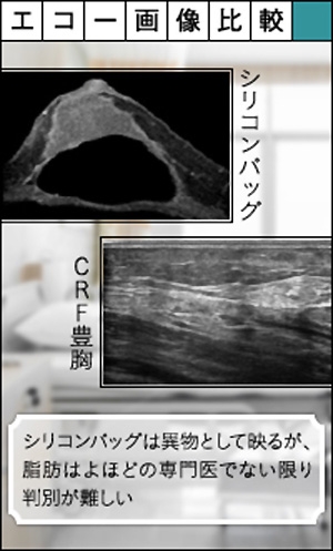 シリコンバッグ エコー
