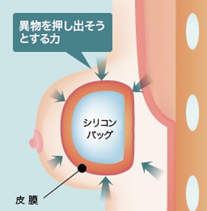 シリコンバッグ カプセル拘縮