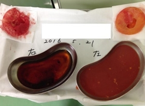 シリコンバッグ 破損 画像