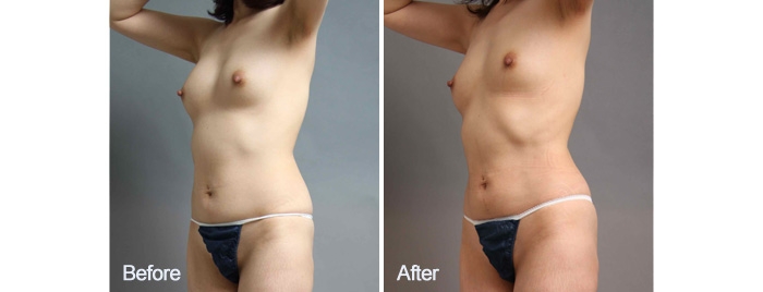 シリコンバッグ 脂肪注入 脂肪採取