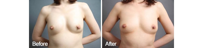 シリコンバッグ豊胸 コンデンスリッチ