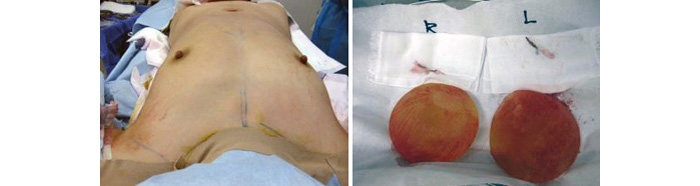 シリコンバッグ豊胸 抜去