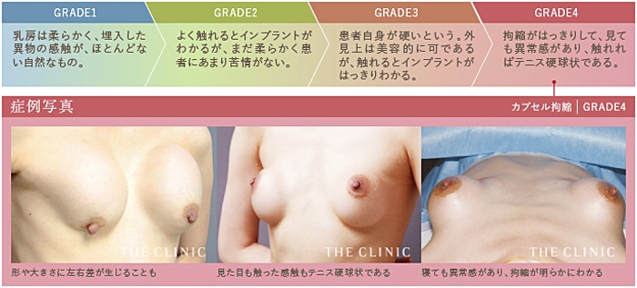 シリコンバッグ カプセル拘縮 レベル