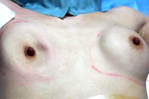 シリコンバッグ 除去 抜去 画像