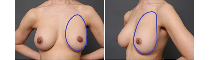 豊胸手術 失敗 画像 症例
