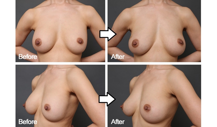 豊胸手術 失敗 画像 症例