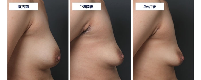 CMCバッグ 除去 カプセル