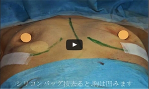 豊胸バッグ 除去 下垂