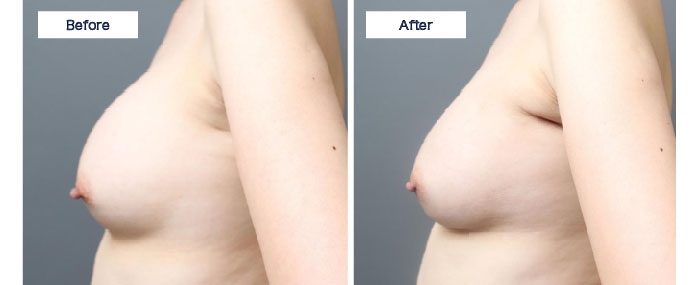 シリコンバッグ 除去 脂肪注入