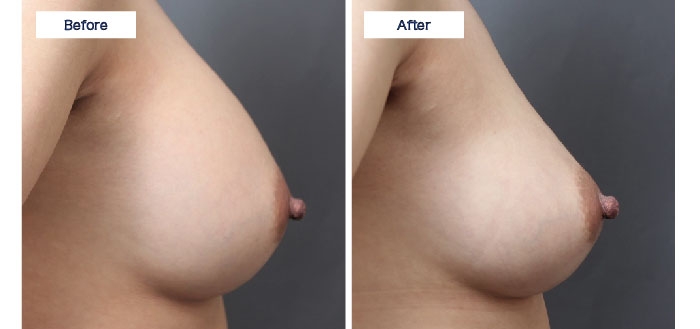 シリコンバッグ 抜去 不自然