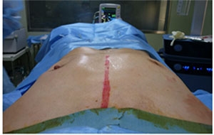 シリコンバッグ除去 破損 カプセル拘縮