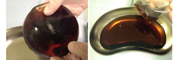 生理食塩水バッグ 除去 劣化