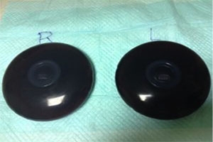 生理食塩水バッグ 除去 劣化