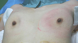 シリコンバッグ 豊胸 除去