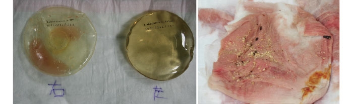 シリコンバッグ 除去 画像