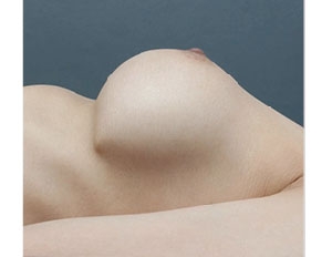 豊胸シリコンバッグのトラブル、リップリングの例