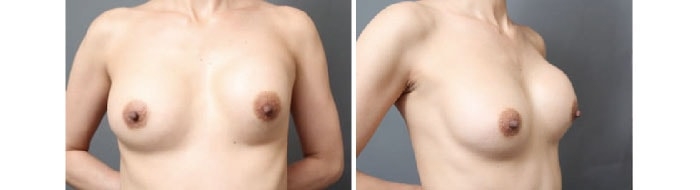 シリコンバッグ豊胸から17年経った胸の状態