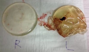 17年間も胸に入っていた豊胸シリコンバッグ