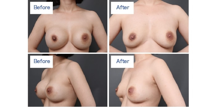 シリコンバッグ豊胸と脂肪注入豊胸の比較画像
