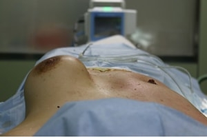 豊胸インプラント除去手術