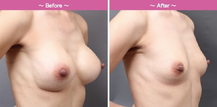 シリコンバッグ除去後の脂肪注入豊胸