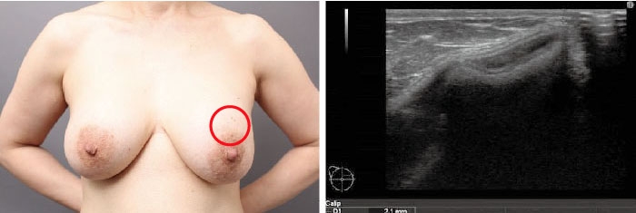 豊胸シリコンバッグのトラブル例