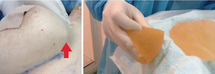 折れ曲がった豊胸シリコンバッグ