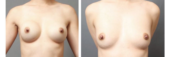 シリコンバッグ豊胸と脂肪注入豊胸の比較画像