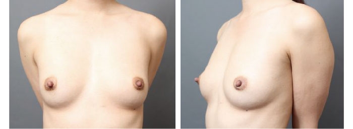 豊胸バッグ除去後の脂肪注入豊胸