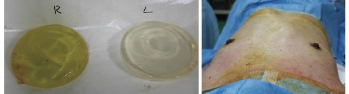 破損した豊胸バッグとくぼんだバスト