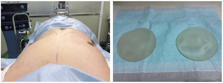 シリコンバッグ抜去後、へこんだ胸