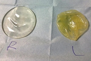 破損したシリコンバッグ