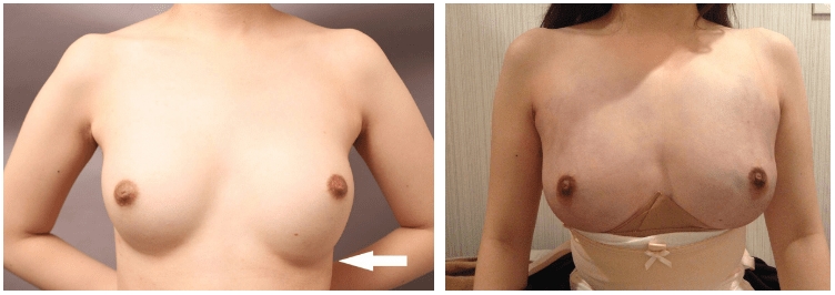 シリコンバッグ豊胸と脂肪注入豊胸の比較
