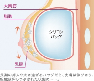 大きな豊胸バッグはバストに大きな負担
