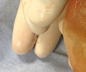 豊胸バッグに糸が縫い付けられていた例