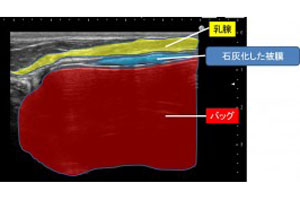 シリコンバッグ抜去